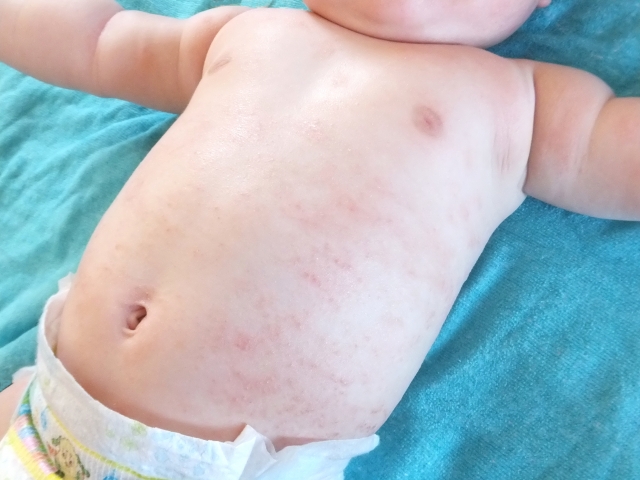 乳児湿疹とは？