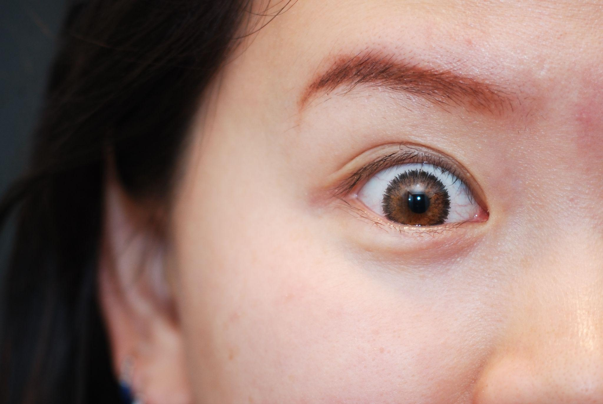 眼瞼下垂手術後のびっくり目とは?原因・症状・対処法を解説