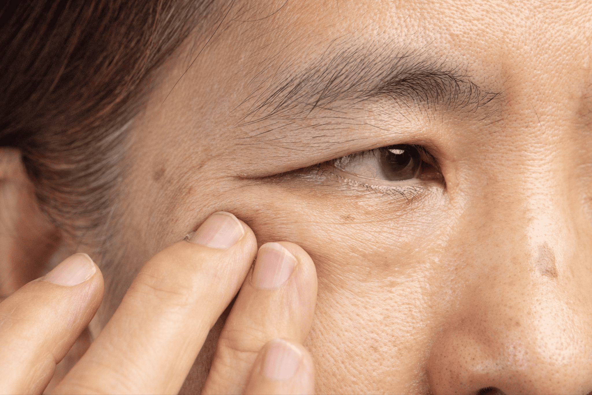 眼瞼下垂とは？