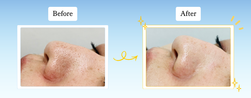 ハイドラジェントルビフォーアフター