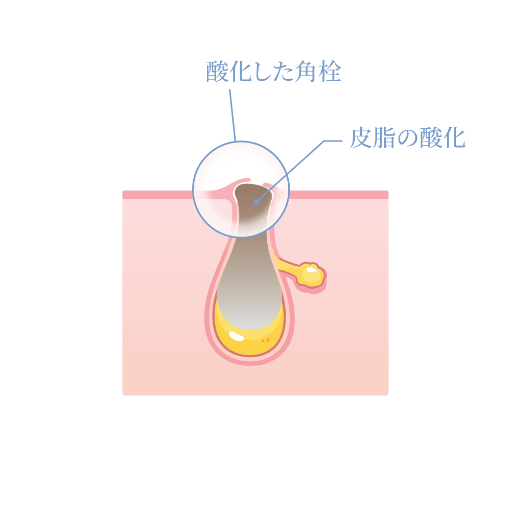 STEP2　BHA（サリチル酸）Tゾーン集中ケア